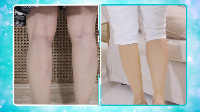 Veins Gone - spray en activatorcrème voor prachtig gladde benen