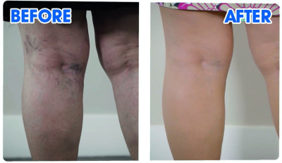 Veins Gone - spray en activatorcrème voor prachtig gladde benen
